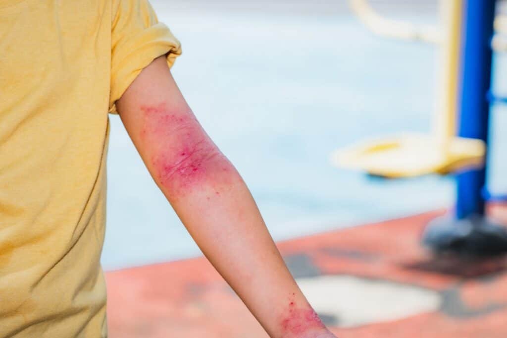 Close up of a child's arm with severe skin rash, inflamed and red in the inner elbow and wrist, indicating atopic dermatitis (eczema) flare up. Useful for medical and health context.