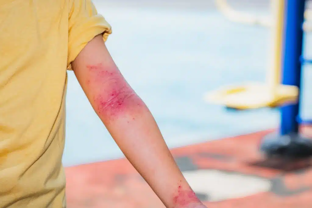 Close up of a child's arm with severe skin rash, inflamed and red in the inner elbow and wrist, indicating atopic dermatitis (eczema) flare up. Useful for medical and health context.
